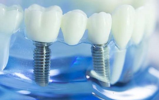 Types of Dental Implant