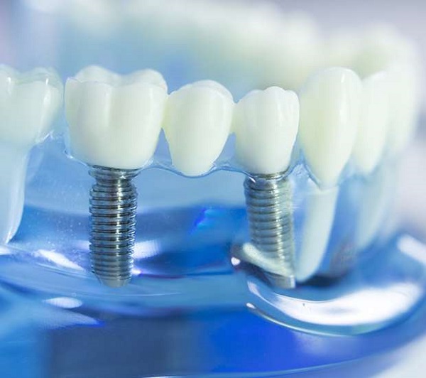 Types of Dental Implant