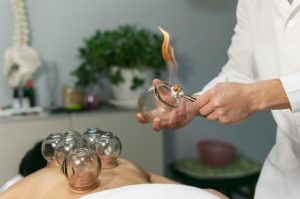 Cupping Therapy for Stress
